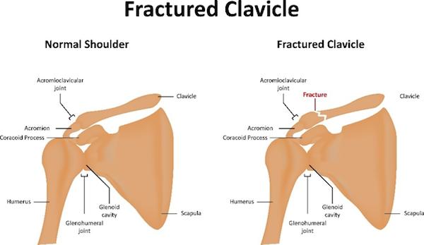 Fractured Clavicle
