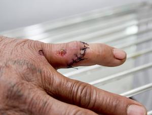 Finger with stitches