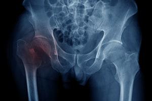 Hip X Ray Fracture