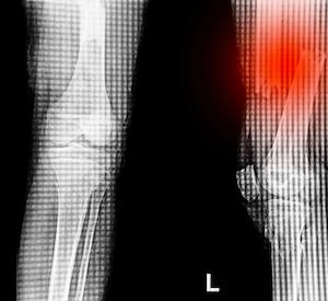 Lef Fracture X Ray