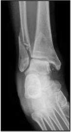 X-Rray Ankle Injury