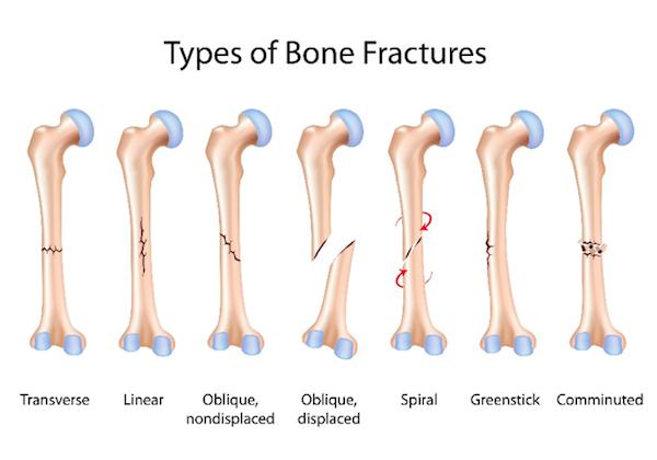 Types of Leg Fractures