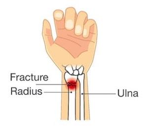 Types of Wrist Injury