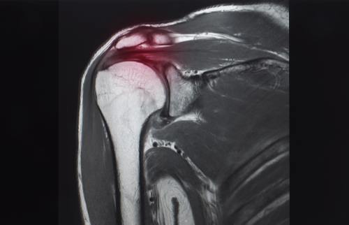 rotator cuff tear