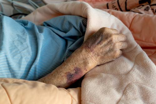 nursing home resident bruise injury