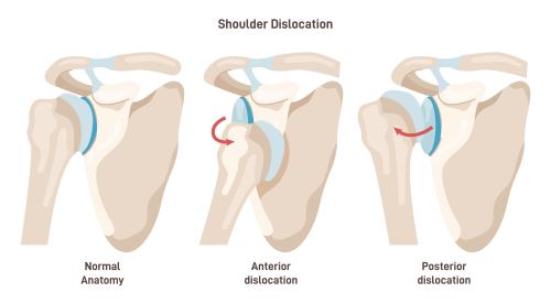 dislocated shoulder injury attorneys
